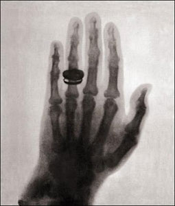 a prima radiografia a raggi X (1896) la mano è della moglie di Röntgen